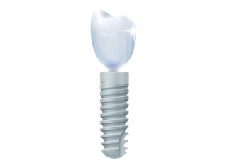 Dental Implant